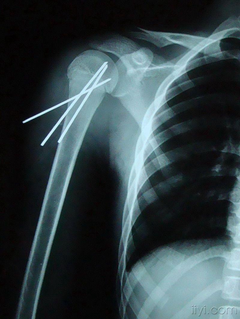 一例儿童肱骨近端骨骺骨折术后感染的深思?(附图)