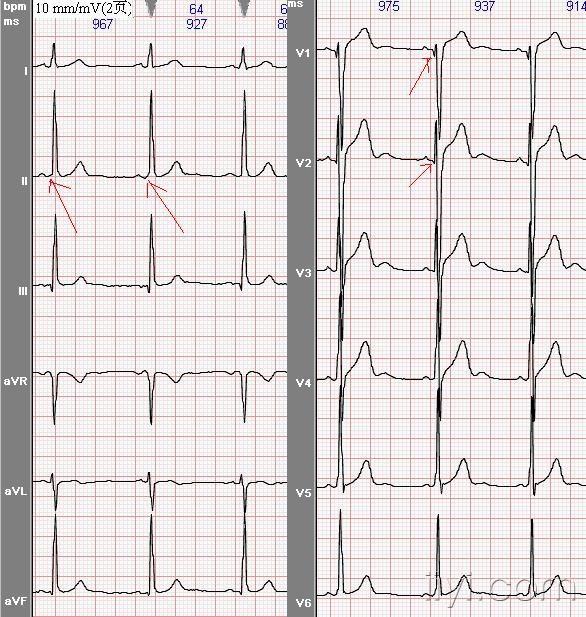 请大家帮忙看看这张心电图有没有问题