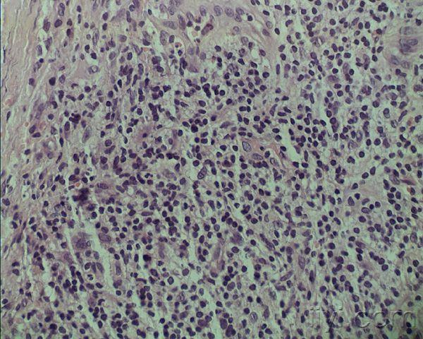 臀部皮肤病如何诊断?