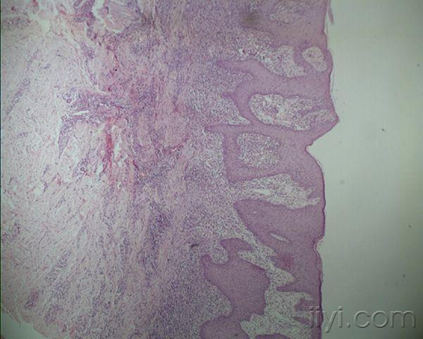 臀部皮肤病如何诊断?