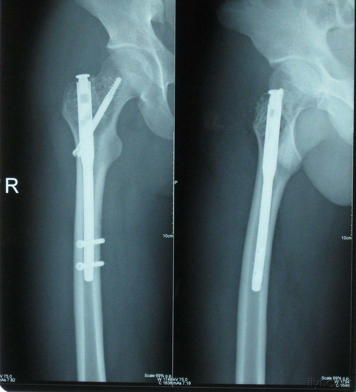 股骨近端骨巨细胞瘤的植骨固定