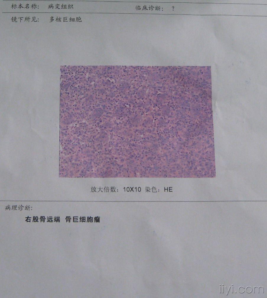 股骨近端骨巨细胞瘤的植骨固定