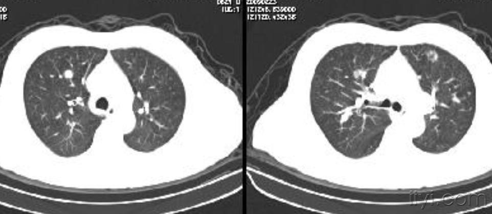 双肺多发结节影 有矽肺病史 医学影像学讨论版 爱爱医医学论坛