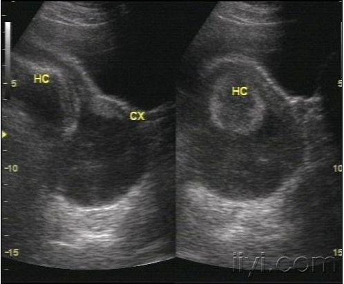 宫颈机能不全 - 超声医学讨论版 - 爱爱医医学论坛
