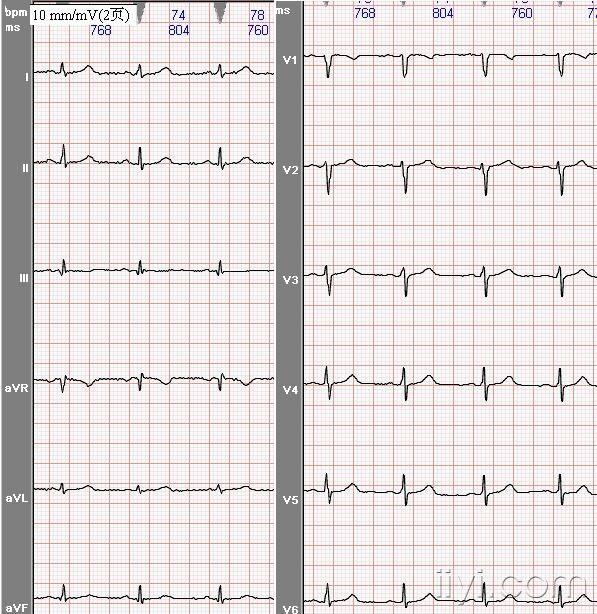 043004-女24岁早孕妇-肢导联胸导联低电压