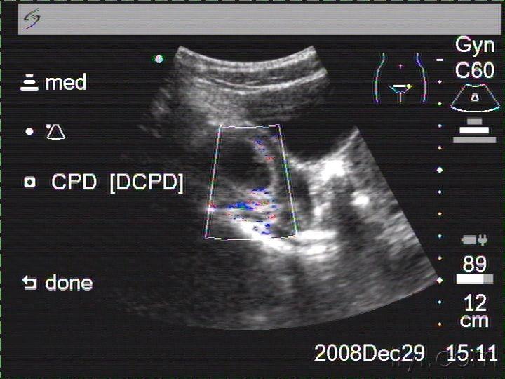 【讨论】双子宫,右侧宫腔妊娠 - 超声医学讨论版 - 医