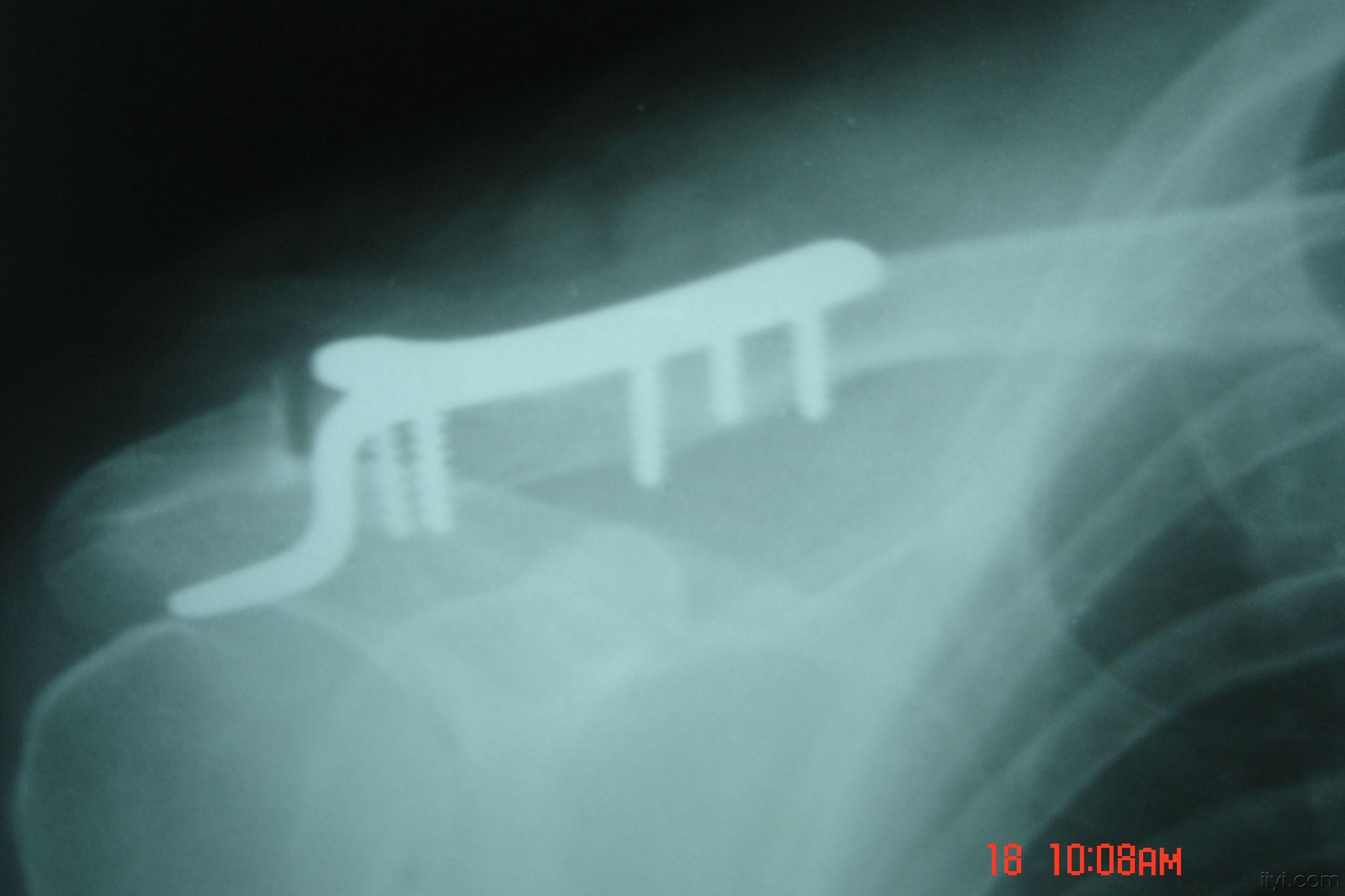 锁骨肩峰端骨折第一次使用钩钢板手术