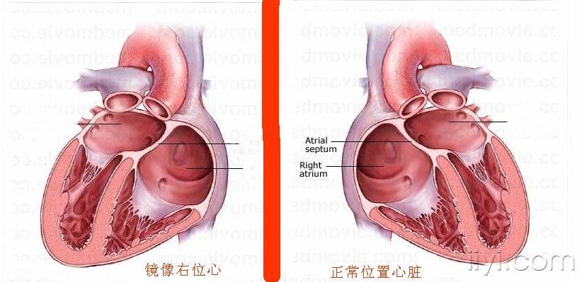 请教冬秋斑竹什么是镜像右位心