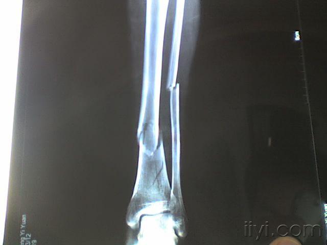 病例讨论:左胫腓骨下段粉碎性骨折,第二跖骨及趾骨骨折.