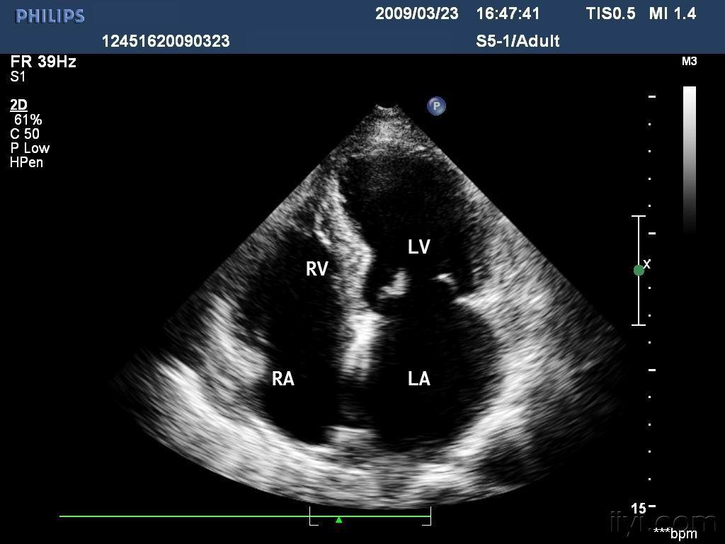 二尖瓣开放时四腔心切面