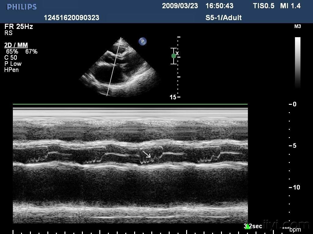 m型显示主动脉瓣无冠瓣呈锯齿样改变