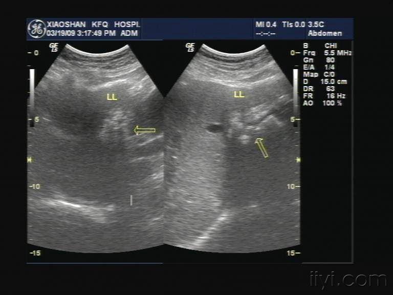 左肝内强回声 - 超声医学讨论版 - 爱爱医医学论坛