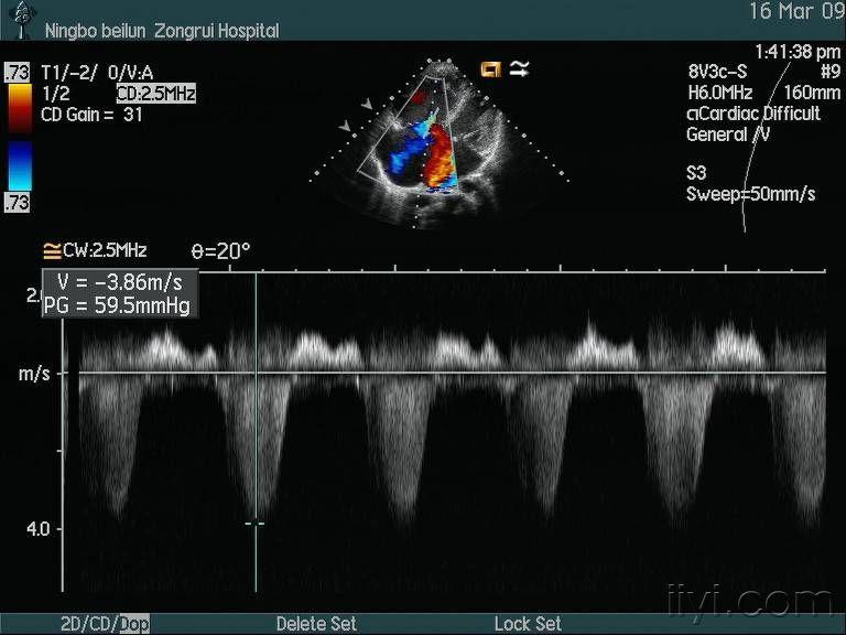心内膜垫缺损(部分型) - 超声医学讨论版 - 爱爱医