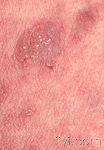 皮肤临床 病理08------蕈样霉菌病