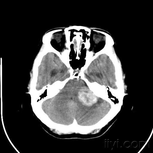原创《桥小脑角区占位性病变—听神经瘤?脑膜瘤?三叉神经鞘瘤?