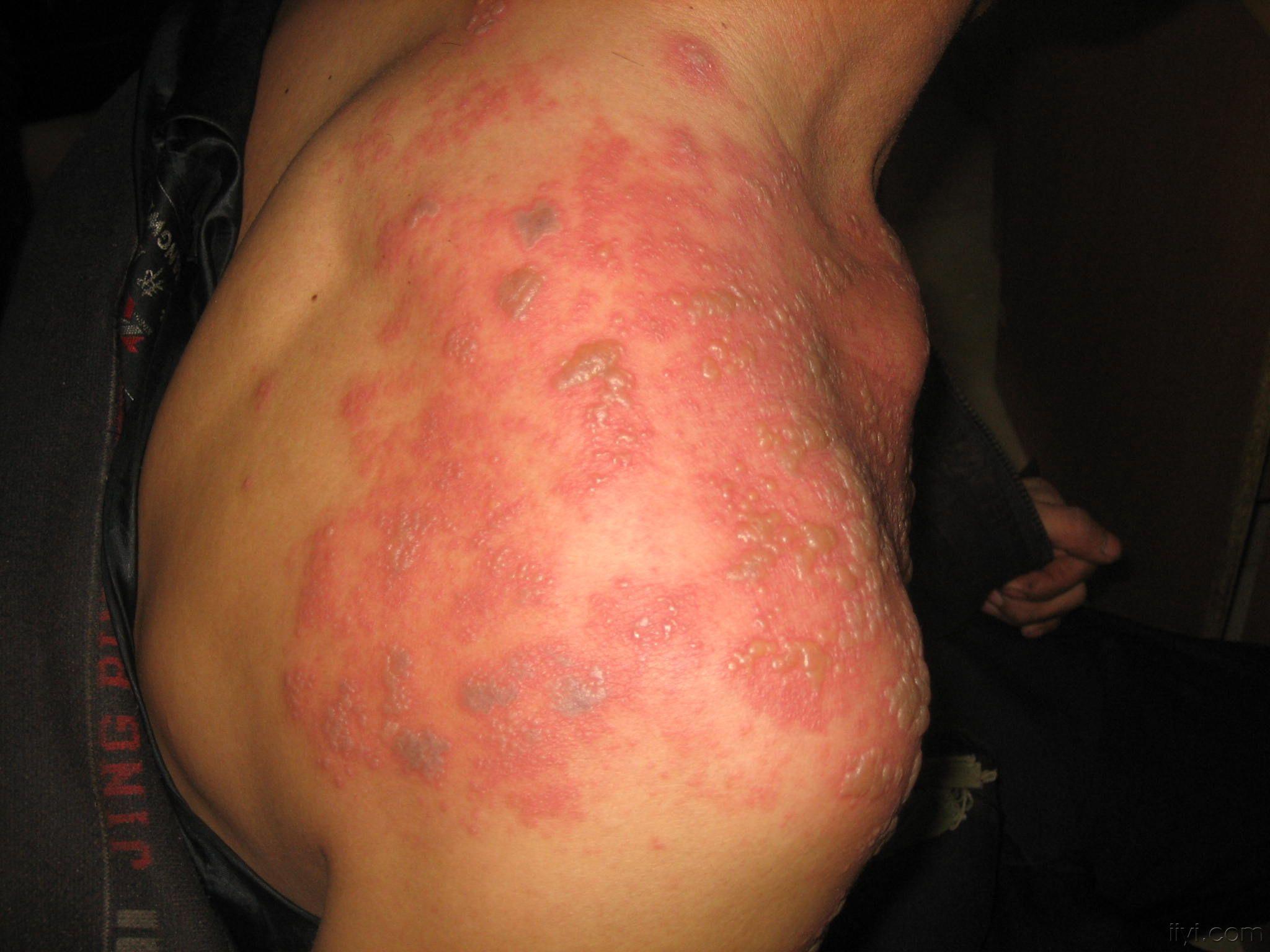 带状疱疹1例