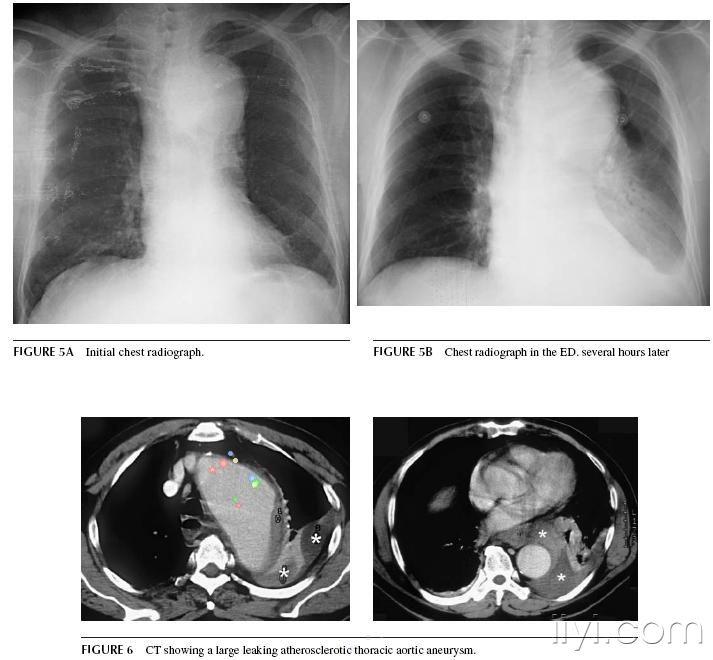 胸片 b 到ed几小时后片       图6 ct示动脉粥样硬化下主动脉瘤大量