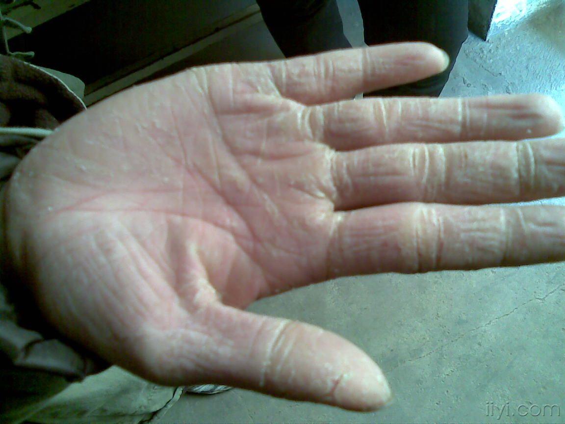 单侧手掌干燥脱皮皲裂一年余