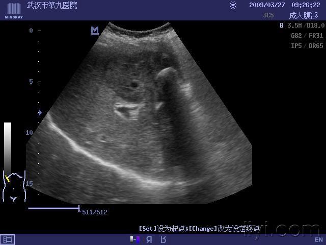 【共享】胆囊癌肝转移一例 超声医学讨论版 爱爱医医学论坛