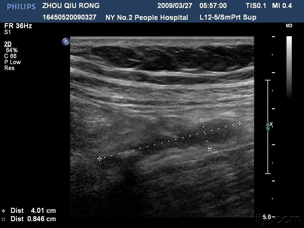阑尾炎(粪石型) - 超声医学讨论版 - 爱爱医医学论坛