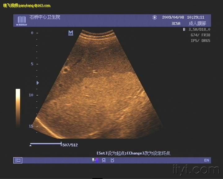 浸润性脂肪肝 超声医学讨论版 爱爱医医学论坛
