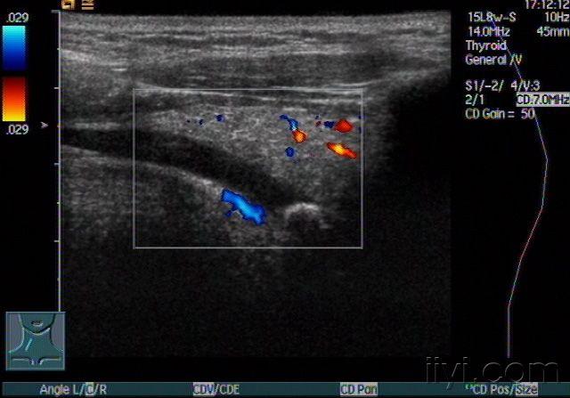 右侧颌下腺导管结石声像图 - 超声医学讨论版 - 爱爱