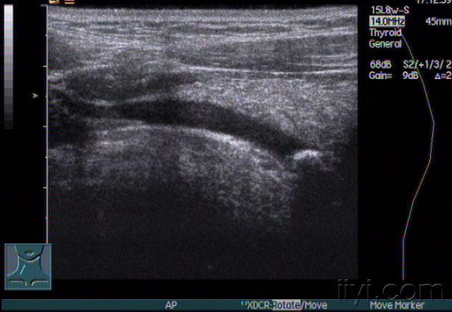 右侧颌下腺导管结石声像图 - 超声医学讨论版 - 爱爱