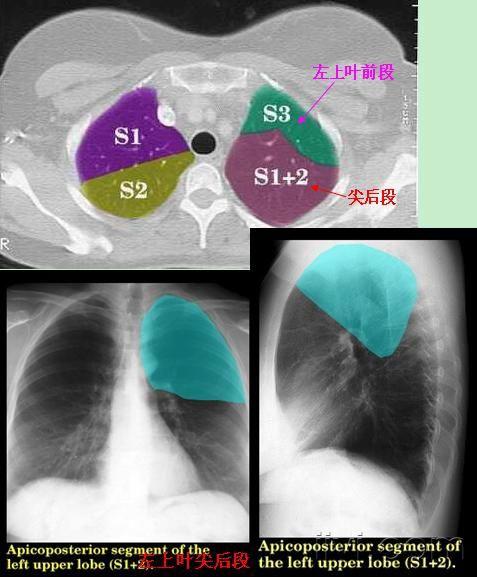 肺叶分段的彩图(左侧,相信很多人在找