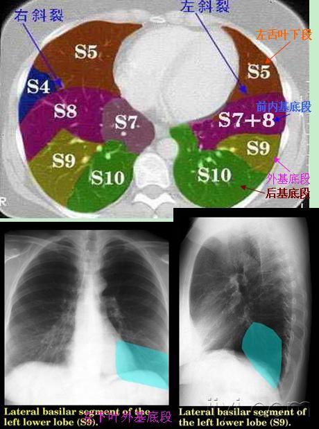 肺叶分段的彩图(左侧),相信很多人在找