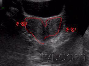 超声诊断鞍形?宫腔镜下说是双子宫?
