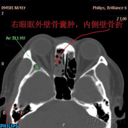 094581--右眼眶外壁囊肿,内壁骨折.jpg