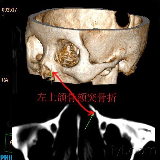 眼鼻上颌窦等的骨折要慢慢的小心的看喔