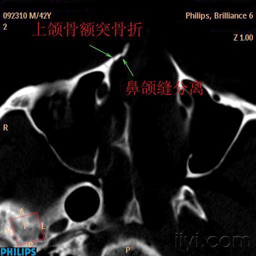 眼鼻上颌窦等的骨折要慢慢的小心的看喔