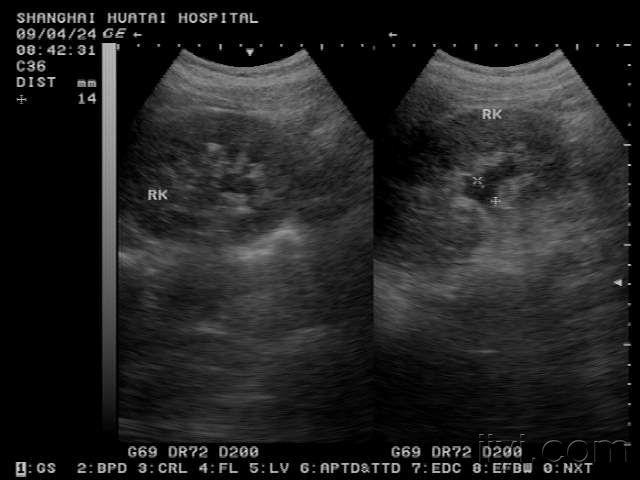 右肾结石及积水 - 超声医学讨论版 - 爱爱医医学论坛