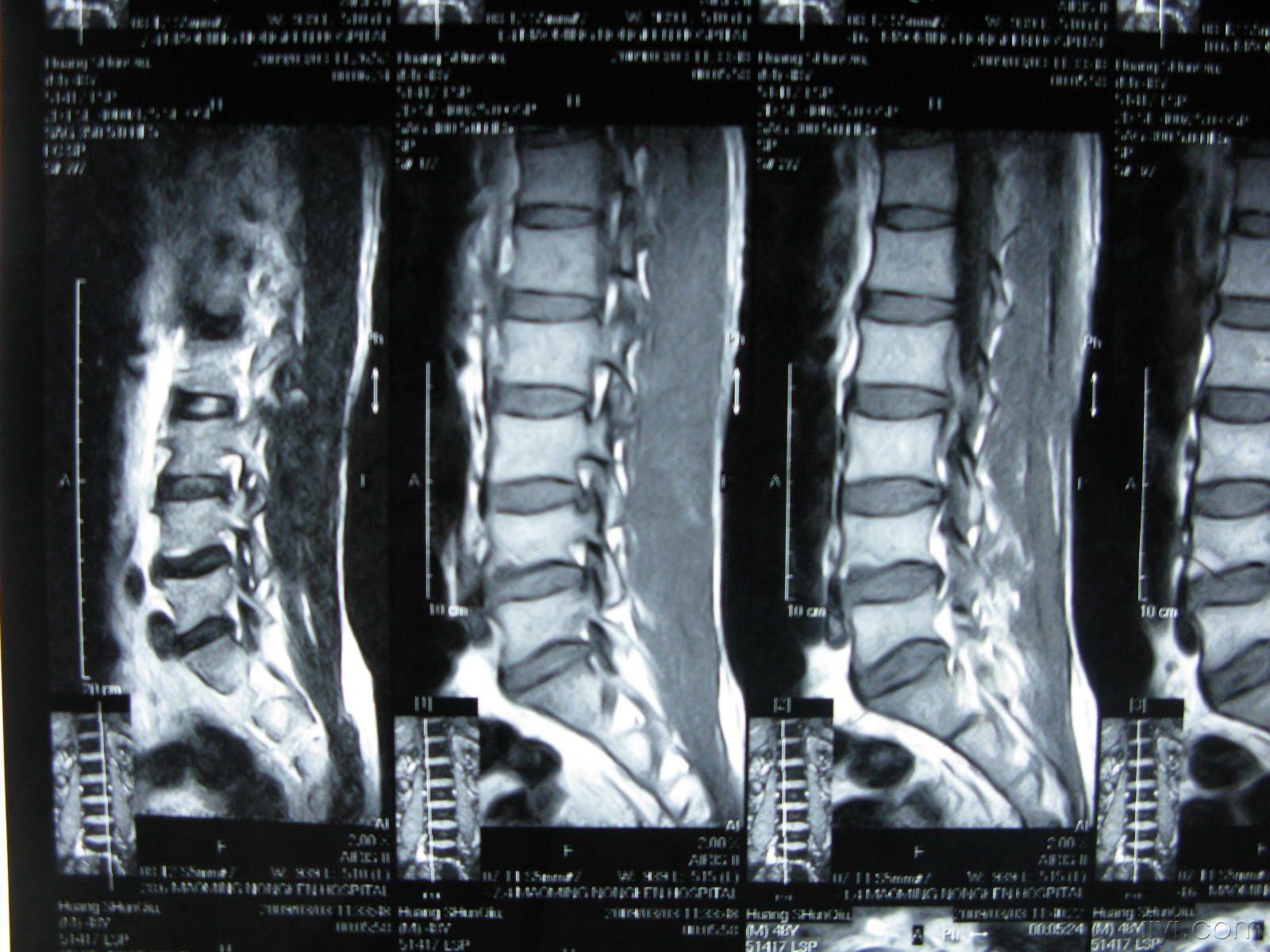 腰椎椎管占位请大家会诊附有ct图片