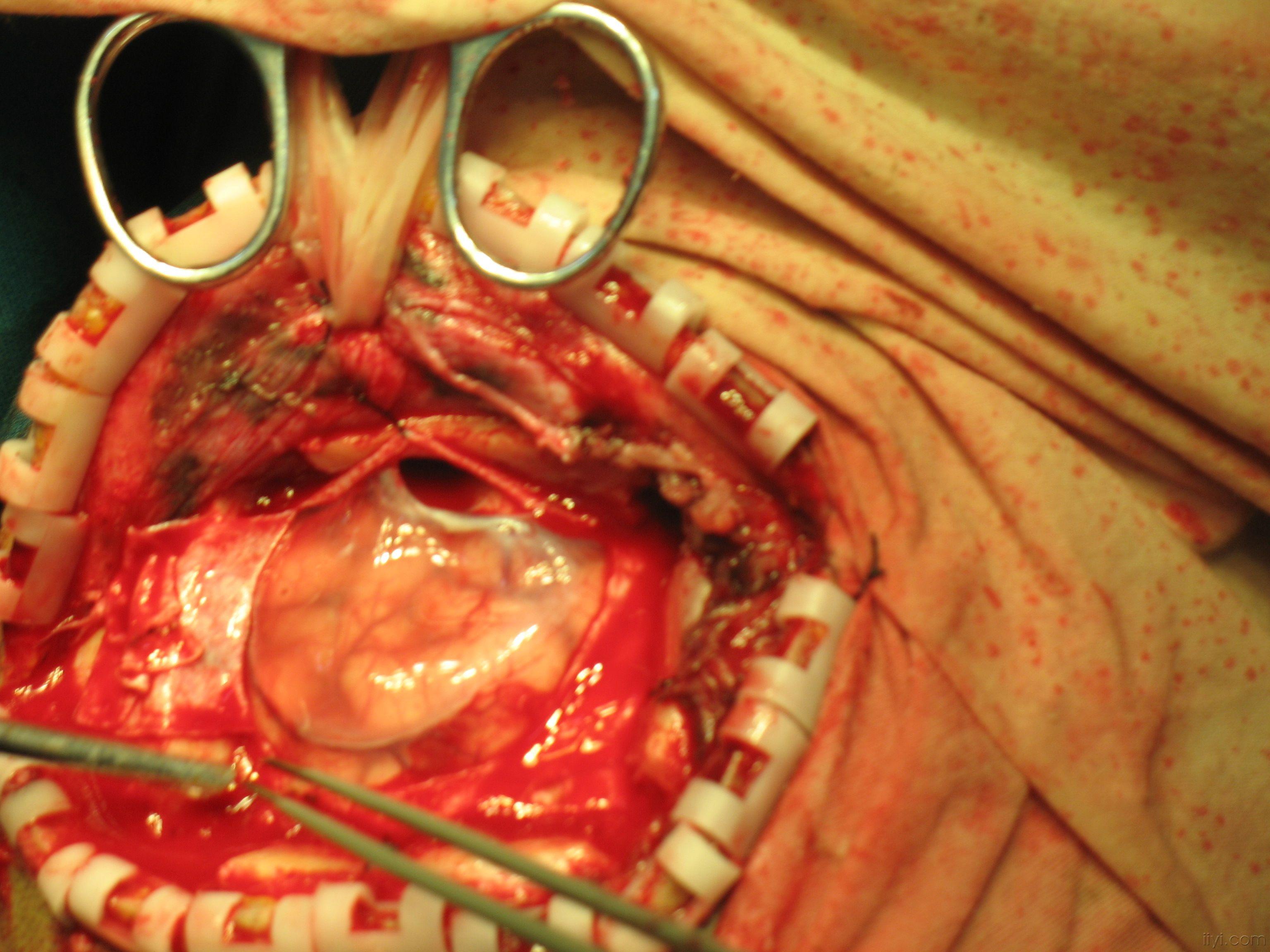 蛛网膜囊肿术中照片