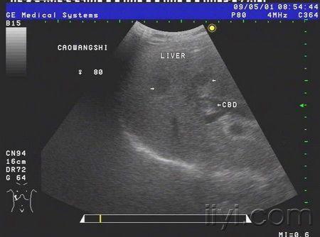 69 胆囊癌合并肝转移    患者女,80岁,食欲不振一月余,查彩超见胆囊