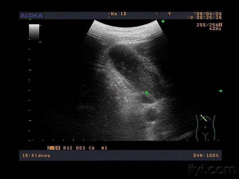 急性胆囊炎 - 超声医学讨论版 - 爱爱医医学论坛