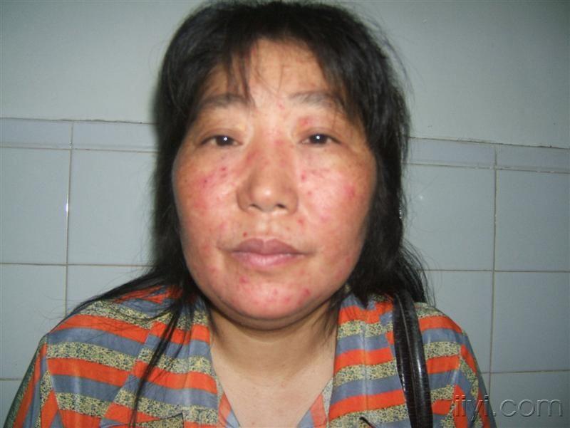 面部红丘疹15年长期使用各种激素药膏