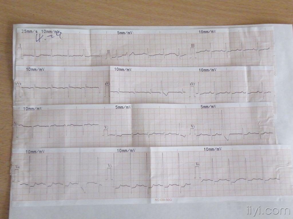 心律失常病例一例求助