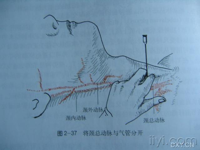 星状神经节阻滞技术与临床应用