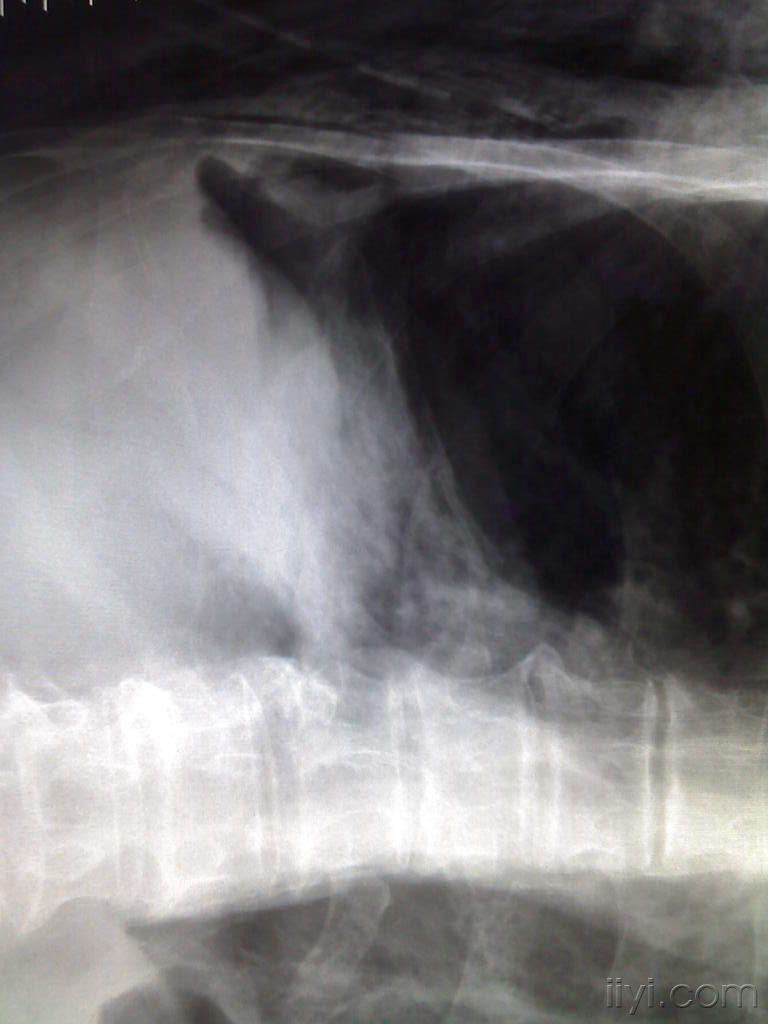 [牙槽]拔牙后的皮下气肿（并发症）