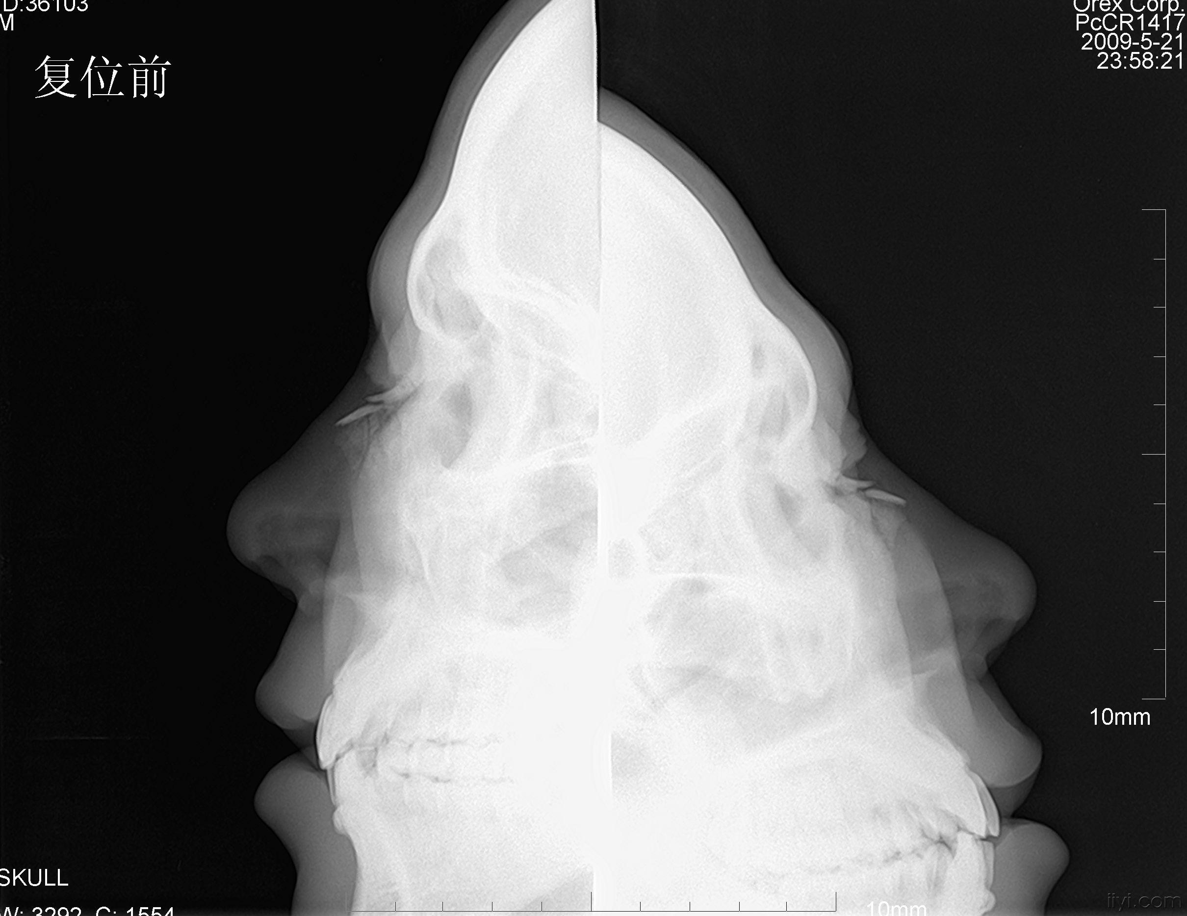 注册x  男性,被他人打伤鼻部2小时入院,入院时摄x光片示鼻骨骨折,当晚