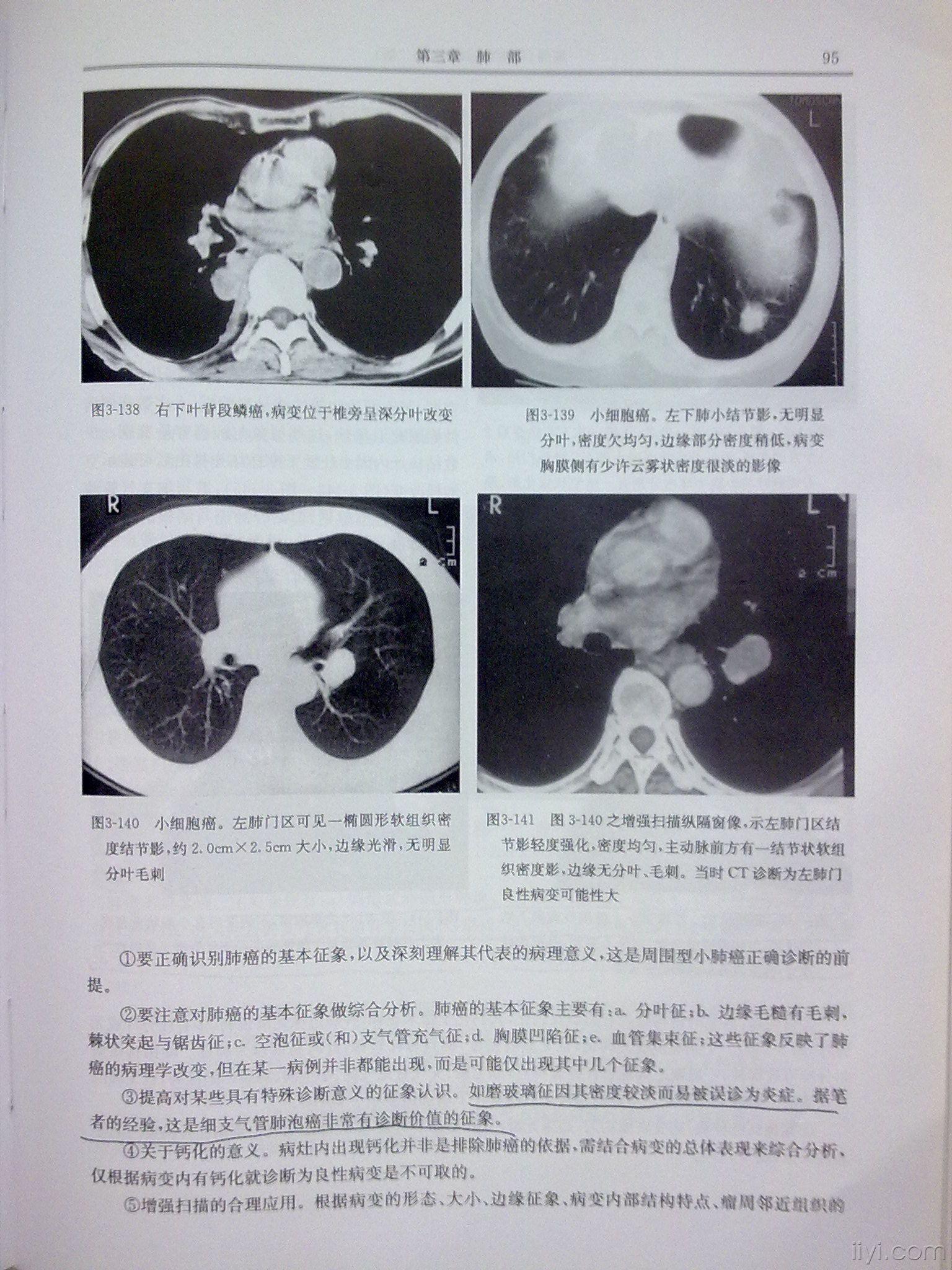 发个帖子,大家共同学习,孤立性肺结节.