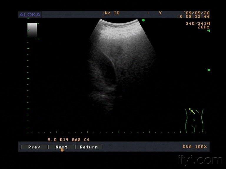 脂肪肝 - 超声医学讨论版 - 爱爱医医学论坛