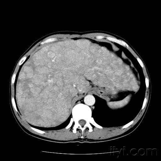 奉献第二例肝脏之典型病例-弥漫型肝细胞型肝癌