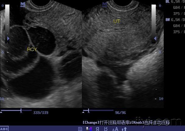 葡萄胎一例(有病理) - 超声医学讨论版 - 爱爱医医学