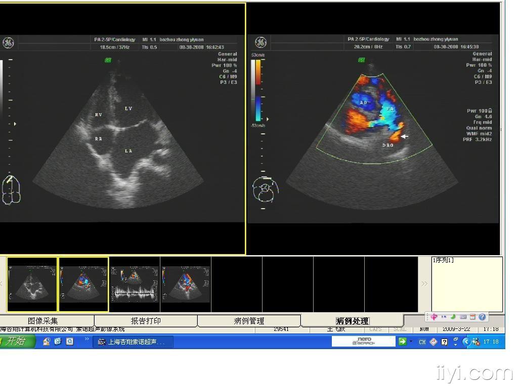 动脉导管未闭一例 - 超声医学讨论版 - 爱爱医医学论坛