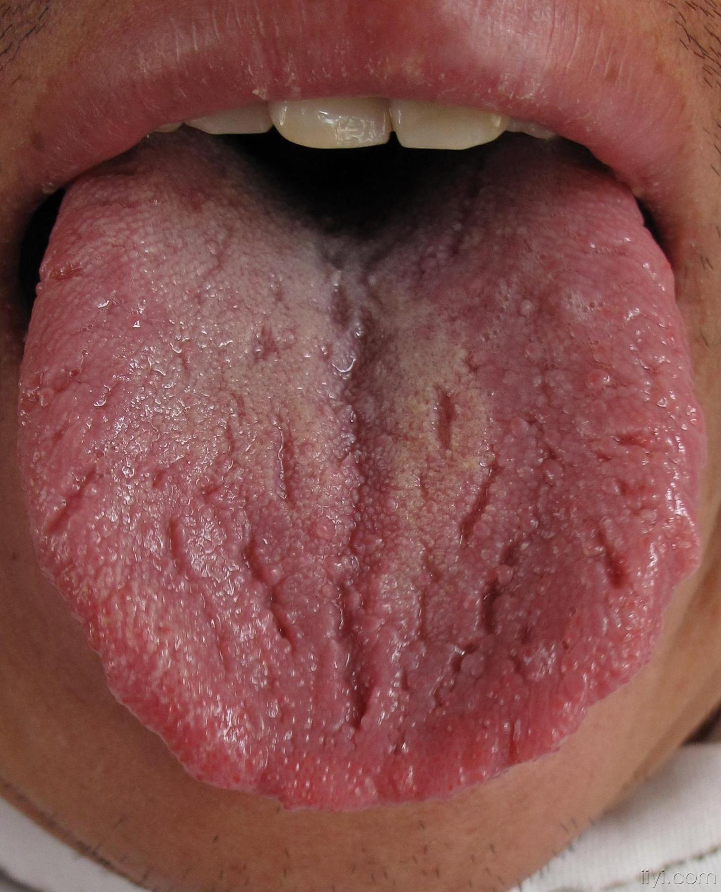 舌的裂纹