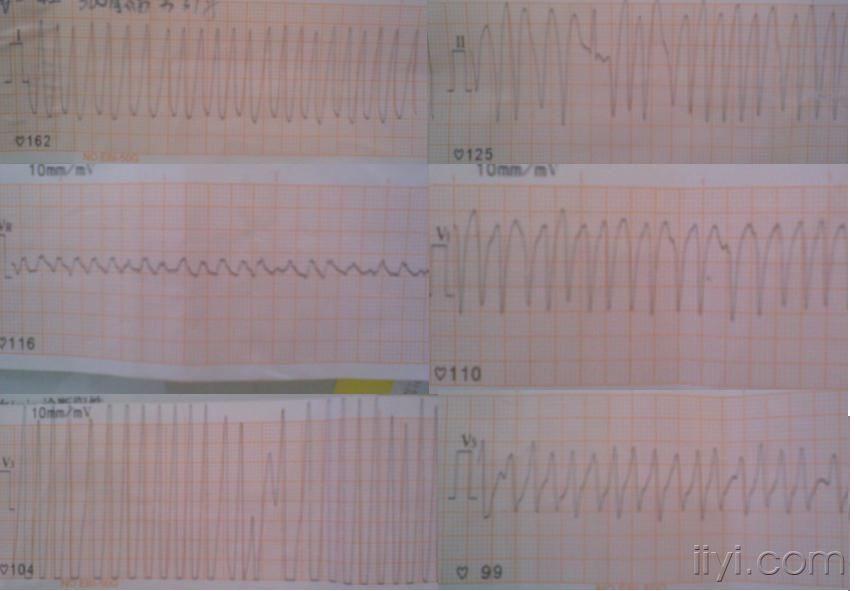 极速  室上速  心电图  综合征